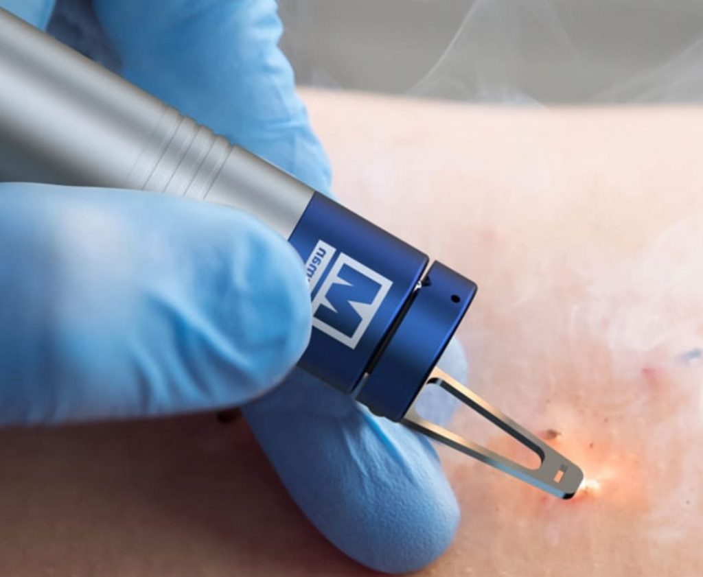 Laser azul valencia seslaser